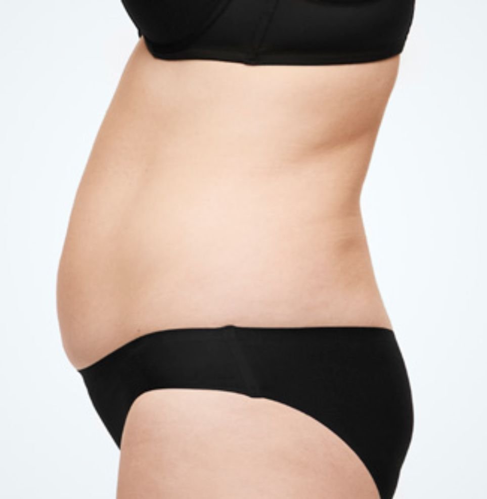 Coolsculpting stomach fat reduction before after london