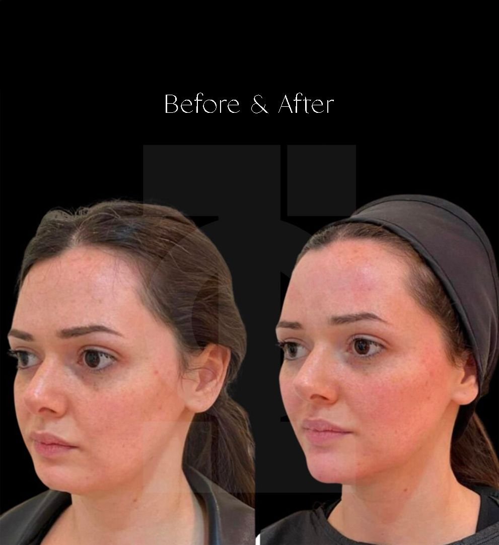 Dermal Fillers London Before and afters.jpeg