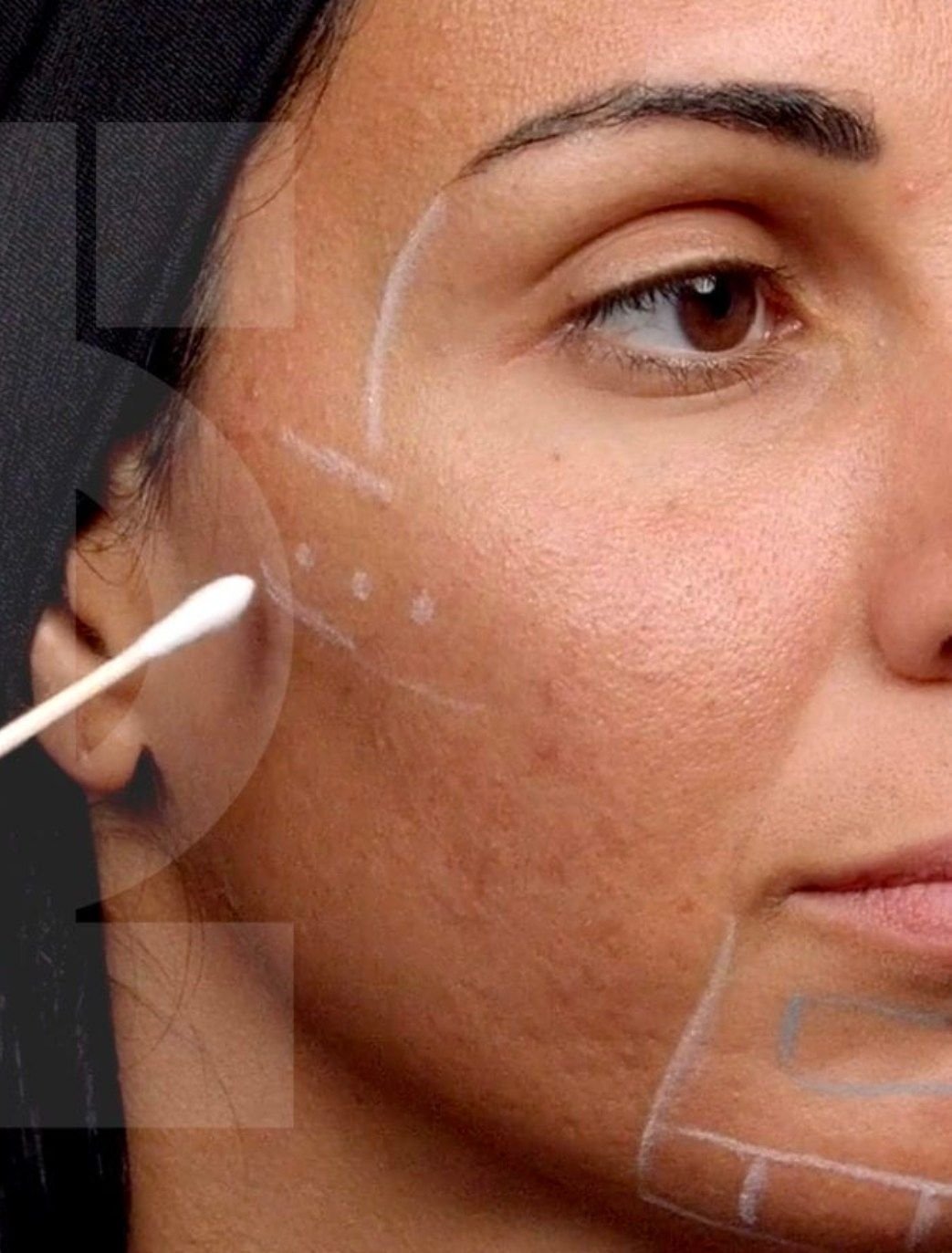Filler in cheeks treatment in london clinic