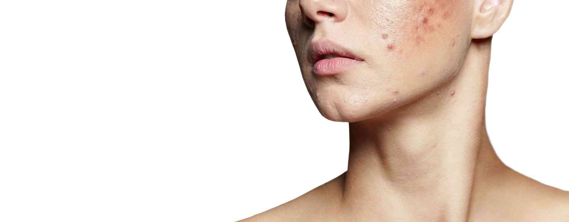 acne scars treatment london phi clinic