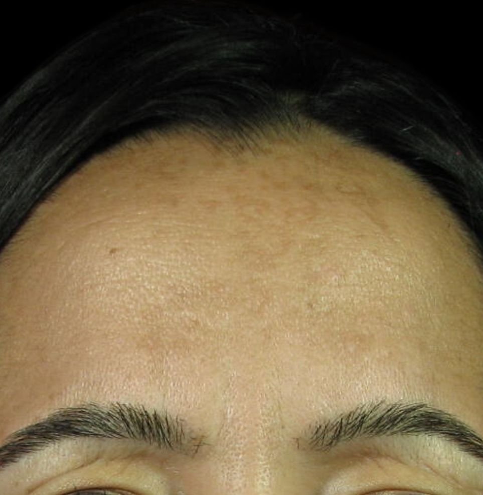 frown lines botox after treatment 