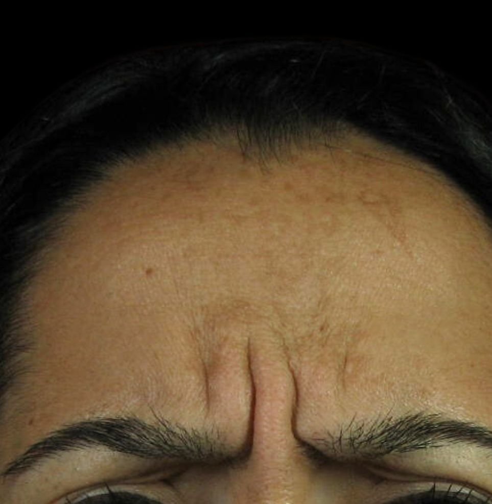 frown lines botox before treatment 