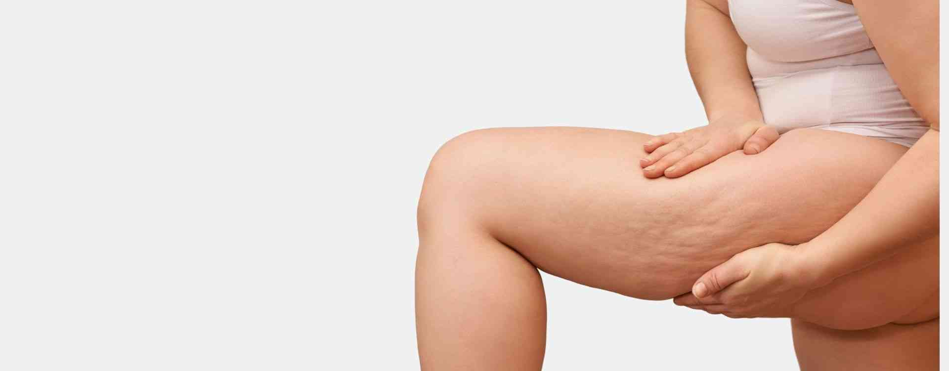 cellulite treatment in london phi clinic
