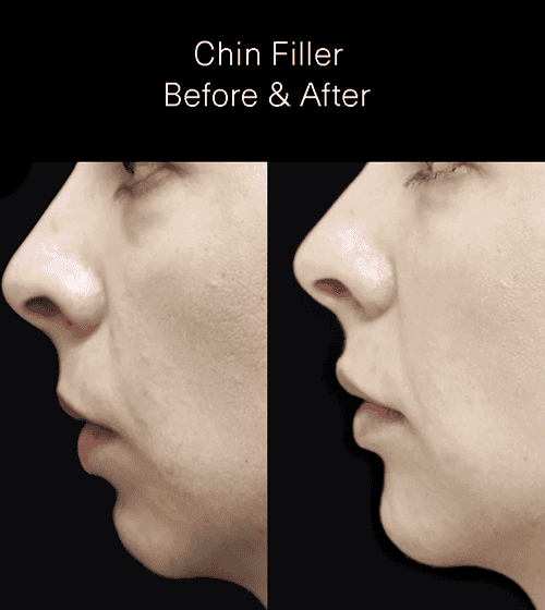 chin filler london before and after.png