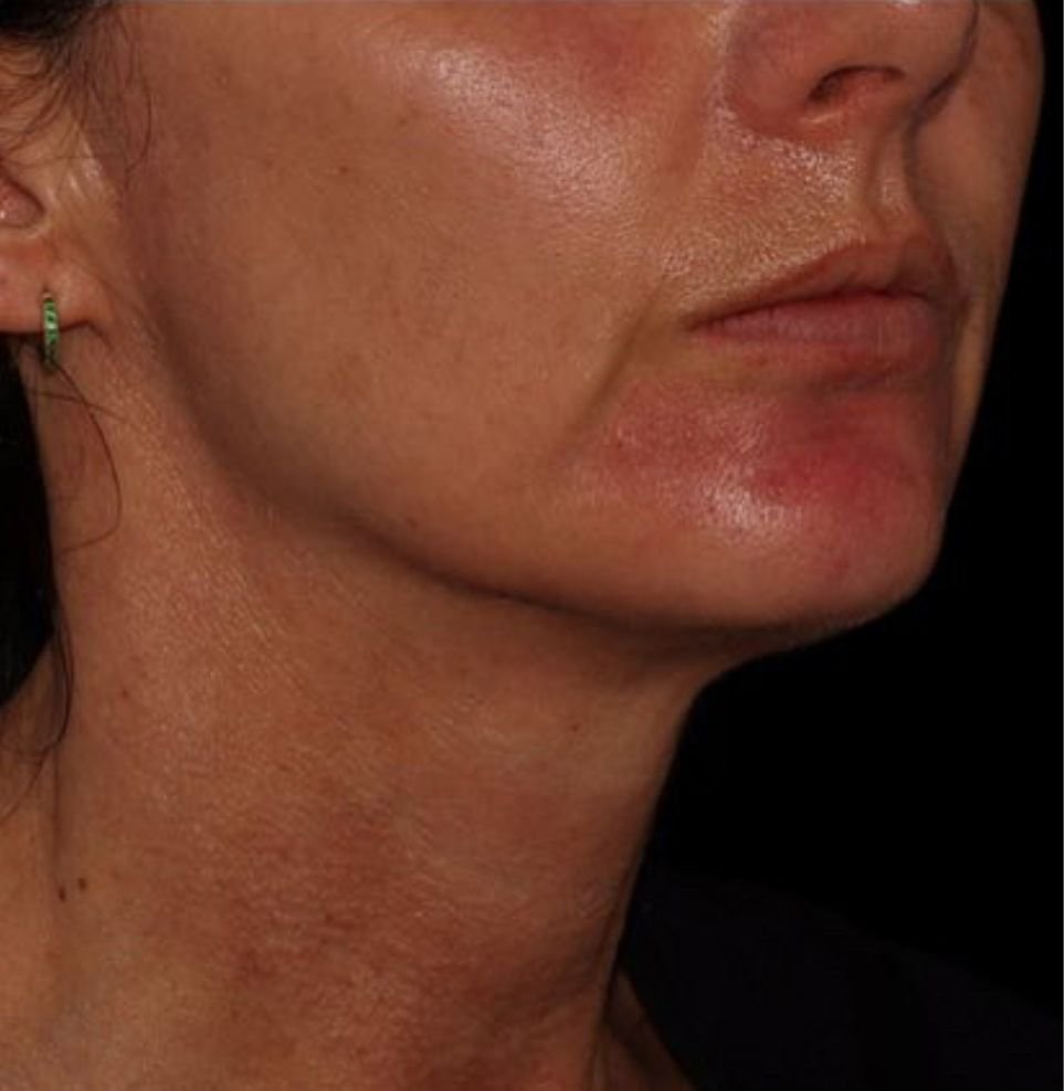 chin treatment london results