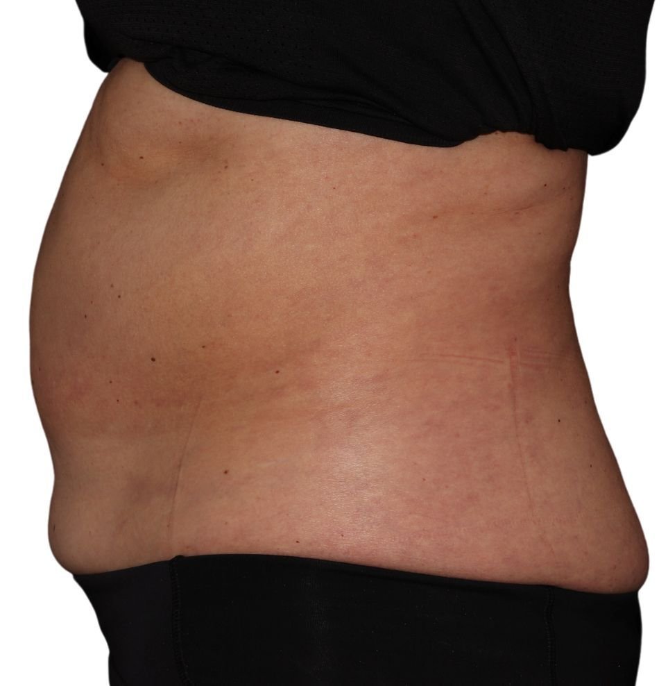 coolsculpting stomach result after