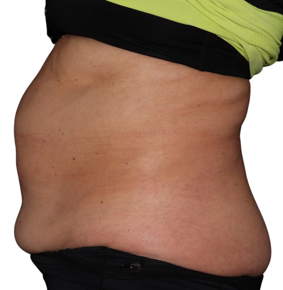 coolsculpting stomach result before