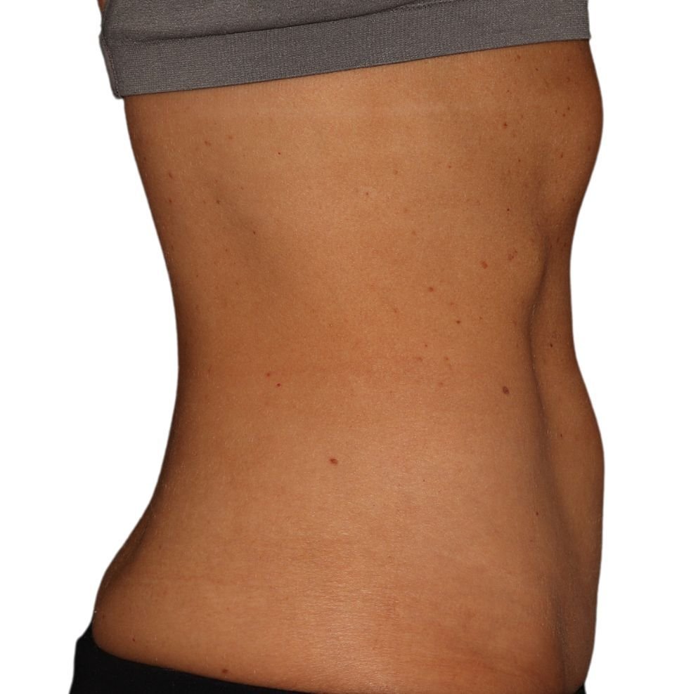 coolsculpting stomach treatment in london result after