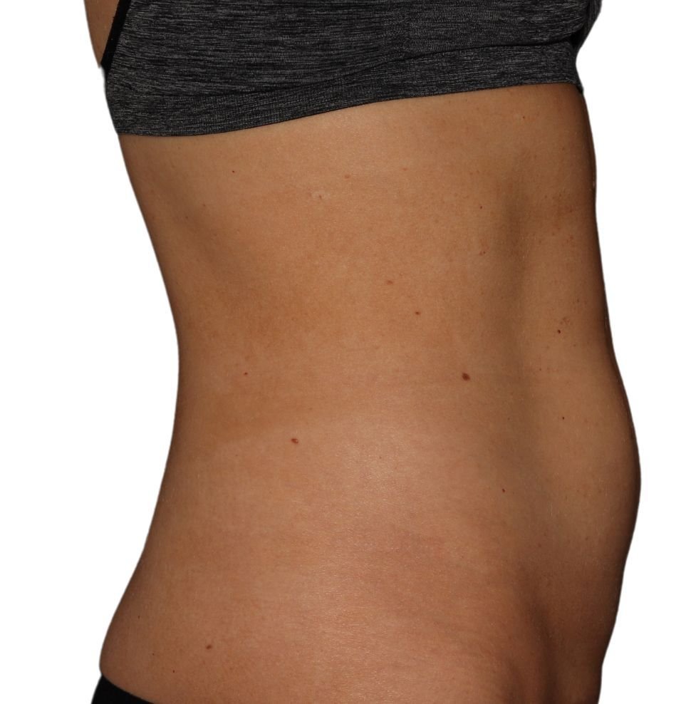 coolsculpting stomach treatment in london result before