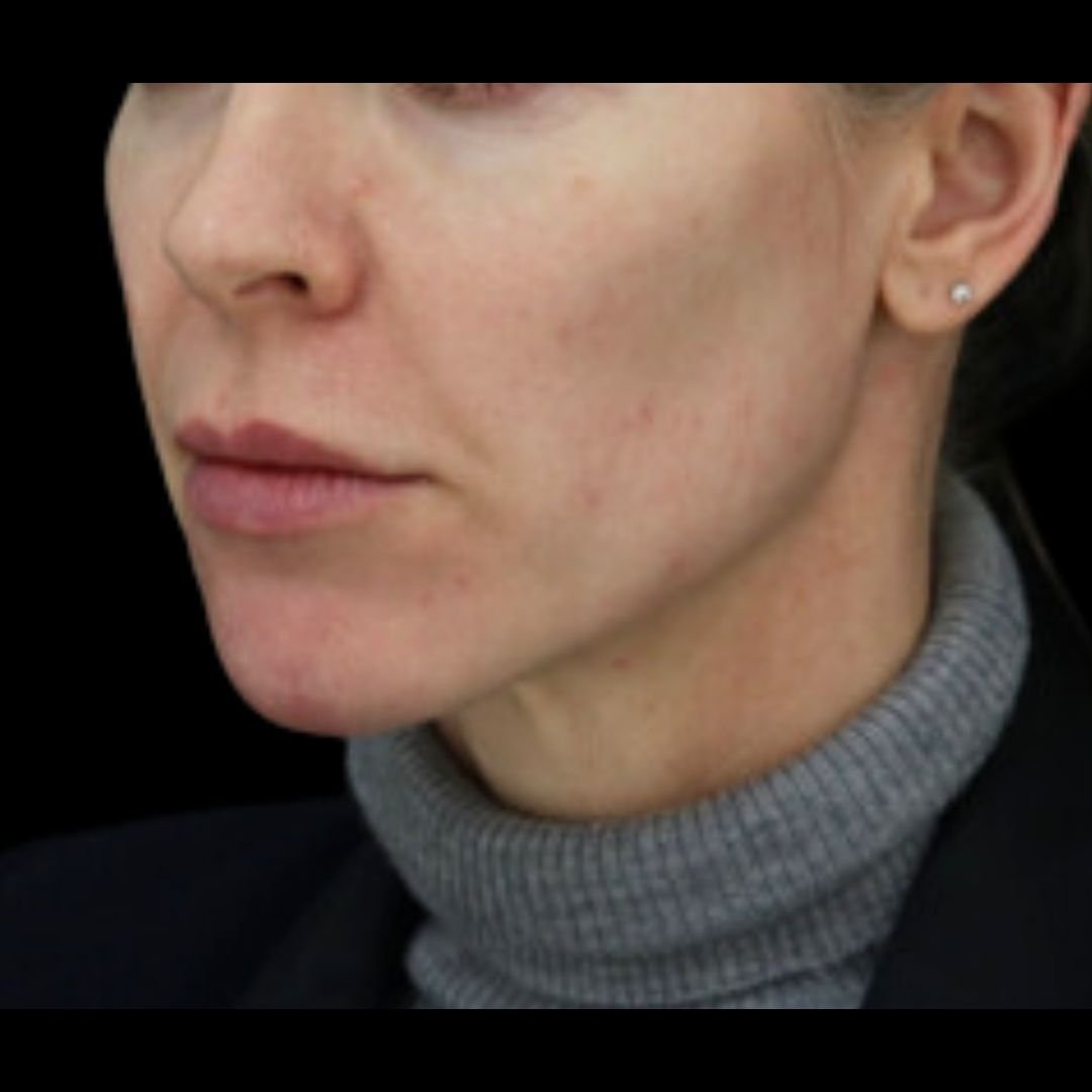 droopy mouth corner botox filler london after