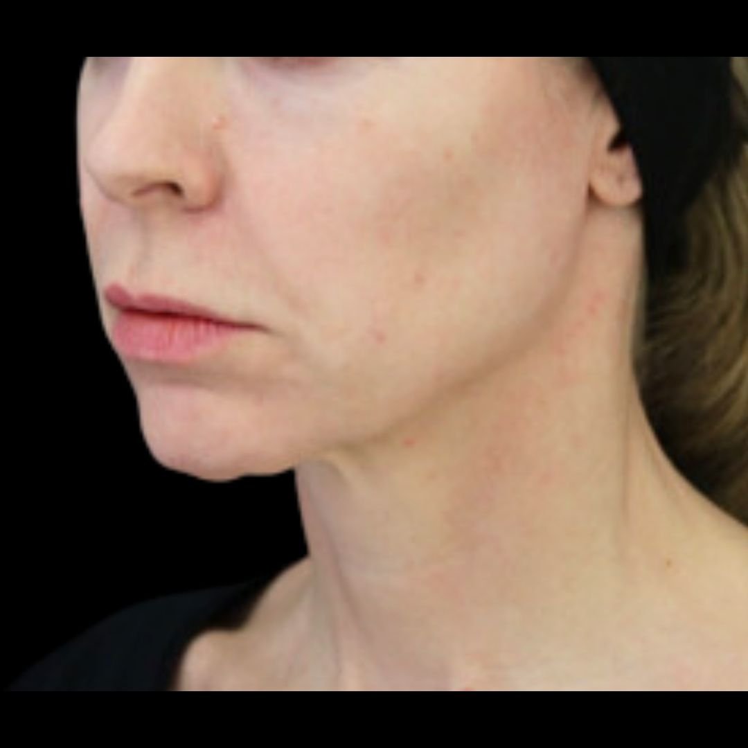 droopy mouth corner botox filler london before