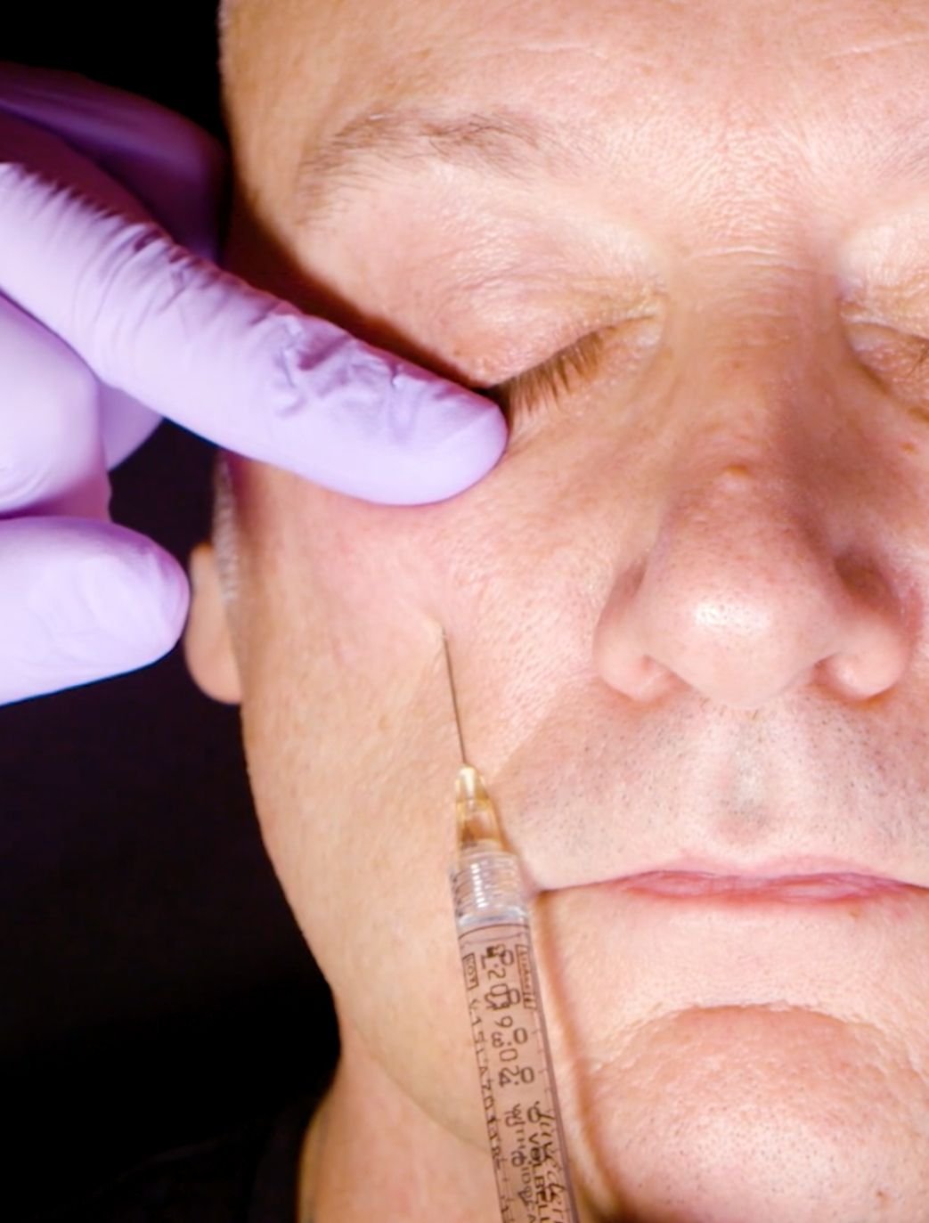eyebag tear trough treatment in london