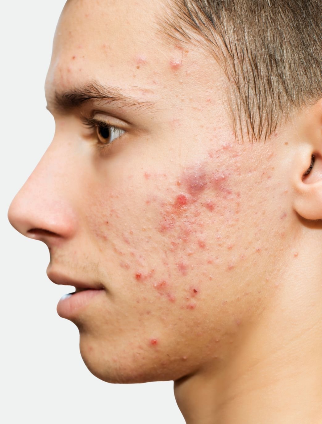 get rid of acne london clinic