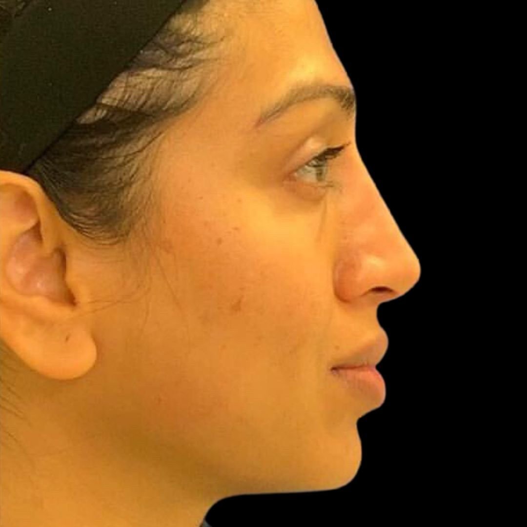 hump on nose filler at phi clinic after