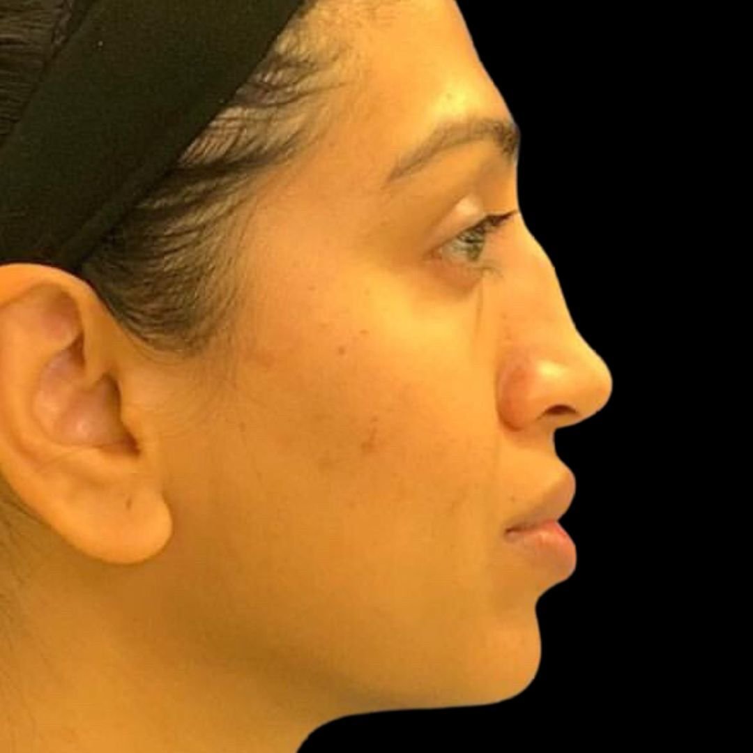 hump on nose filler at phi clinic before