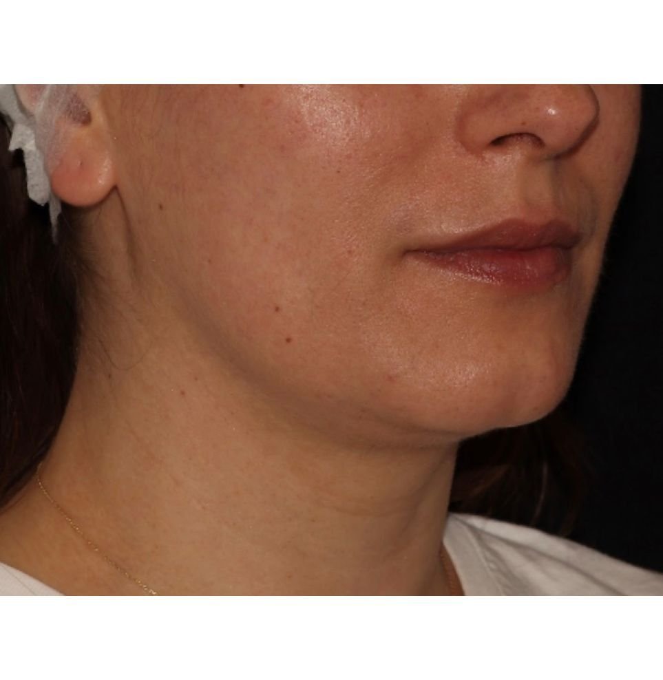 jawline chin endolift tightening results after