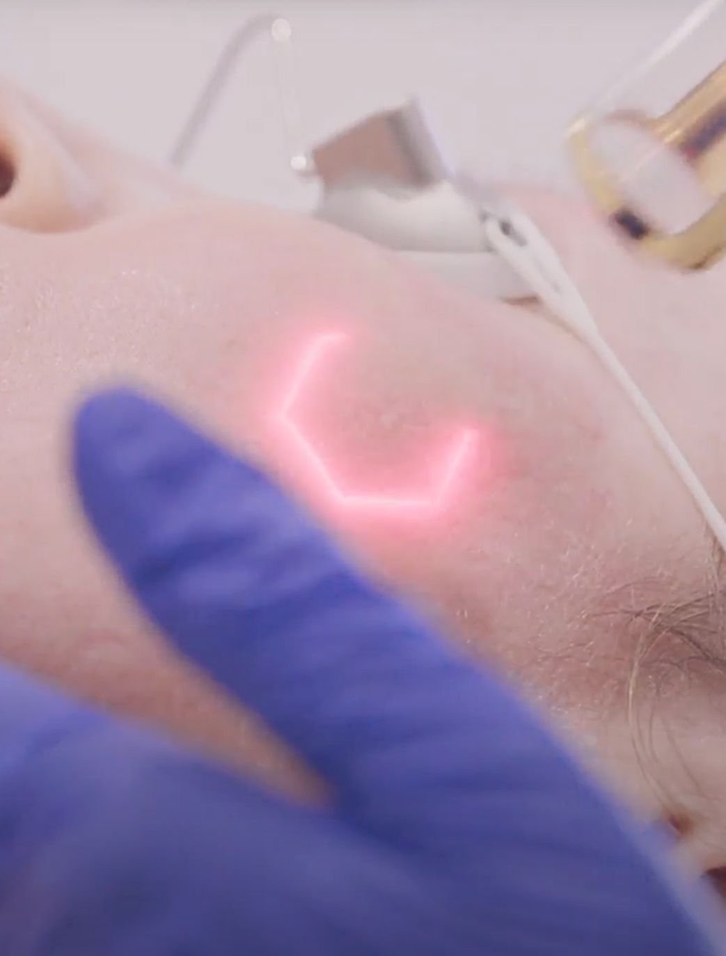 laser skin treatment in london