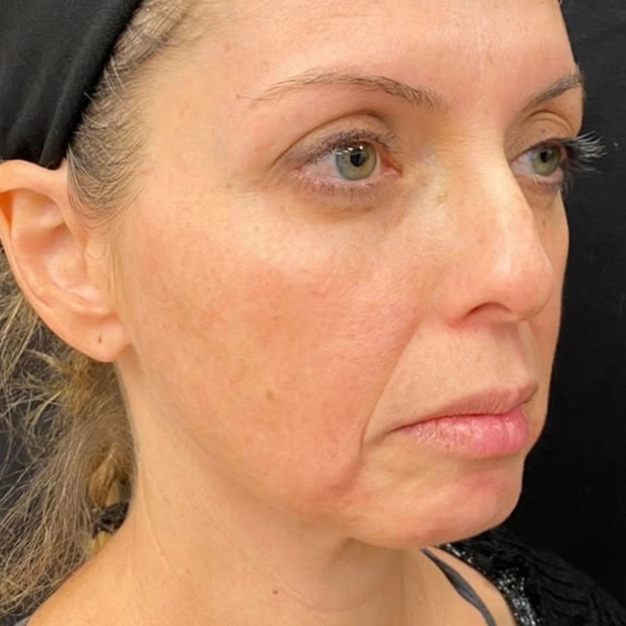 dermal fillers non surgical facelift before and after