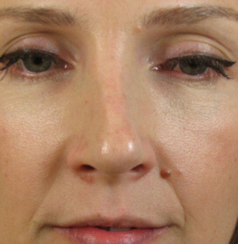 non surgical nose job in london before