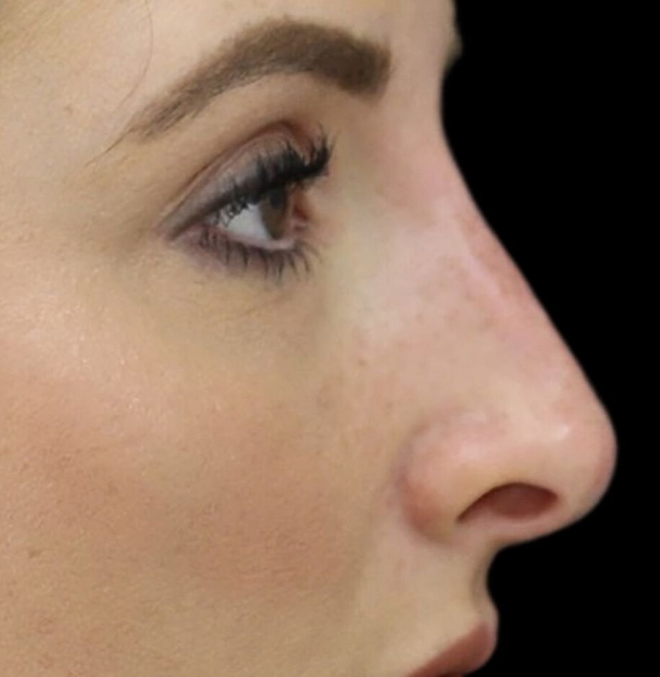 non surgical nose job result in london after