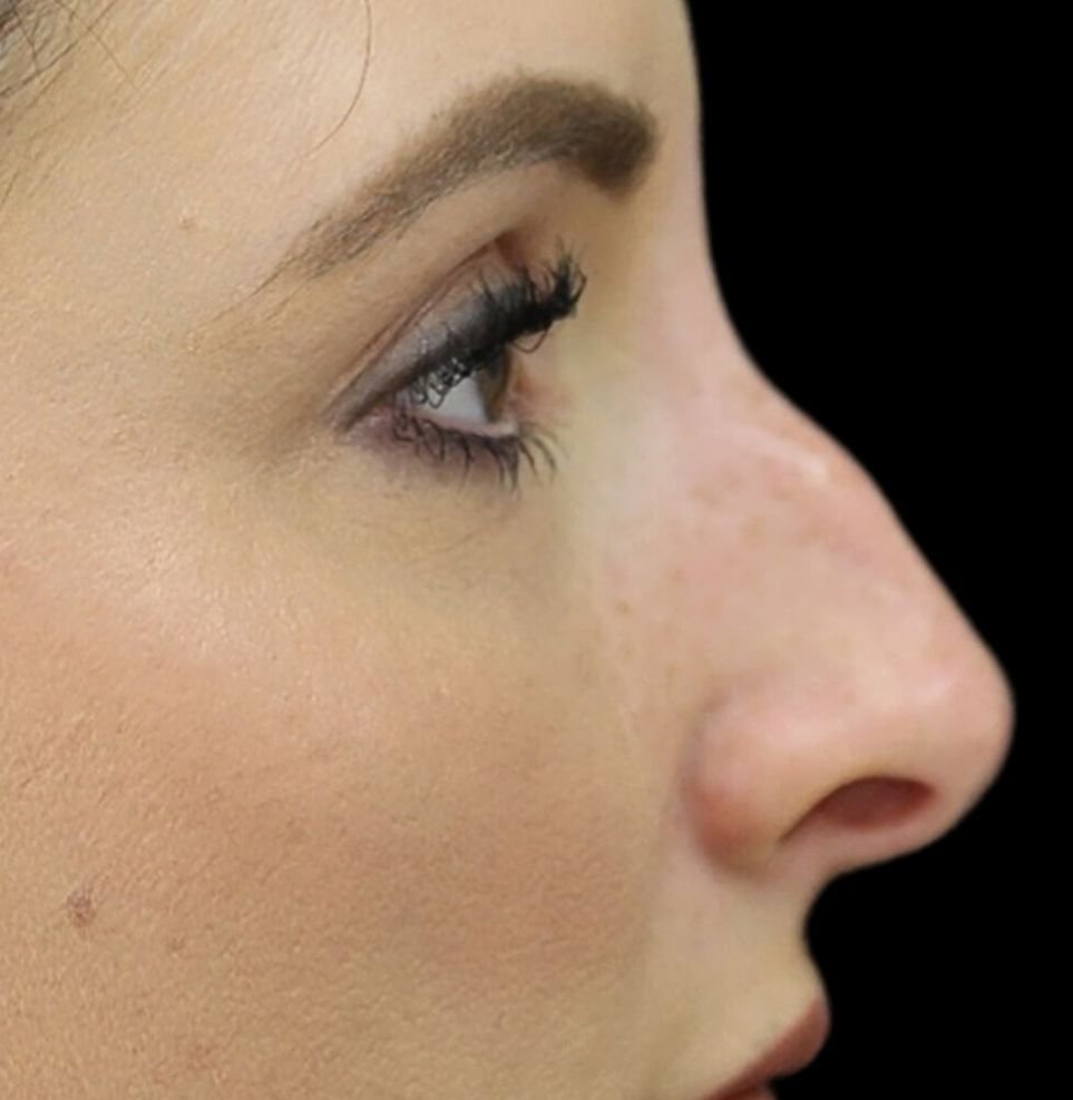 non surgical nose job result in london before