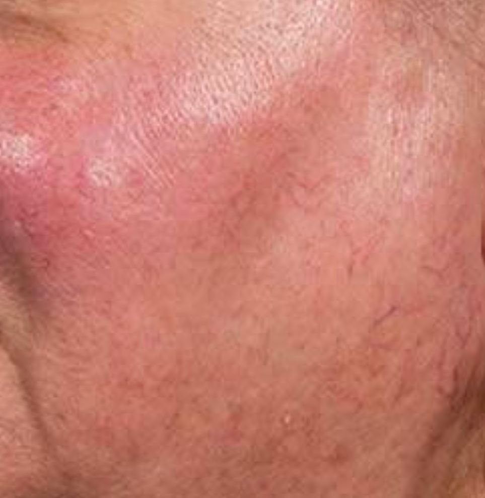 red veins treatment result after