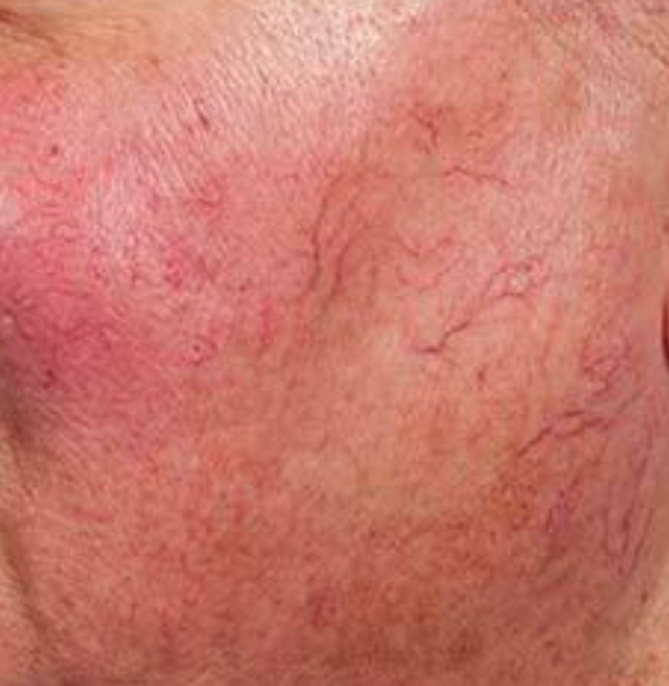 red veins treatment result before