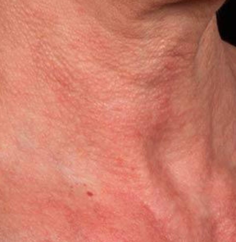 redness on neck treatment after