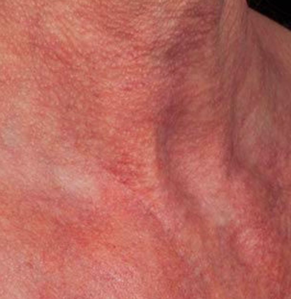 redness on neck treatment before