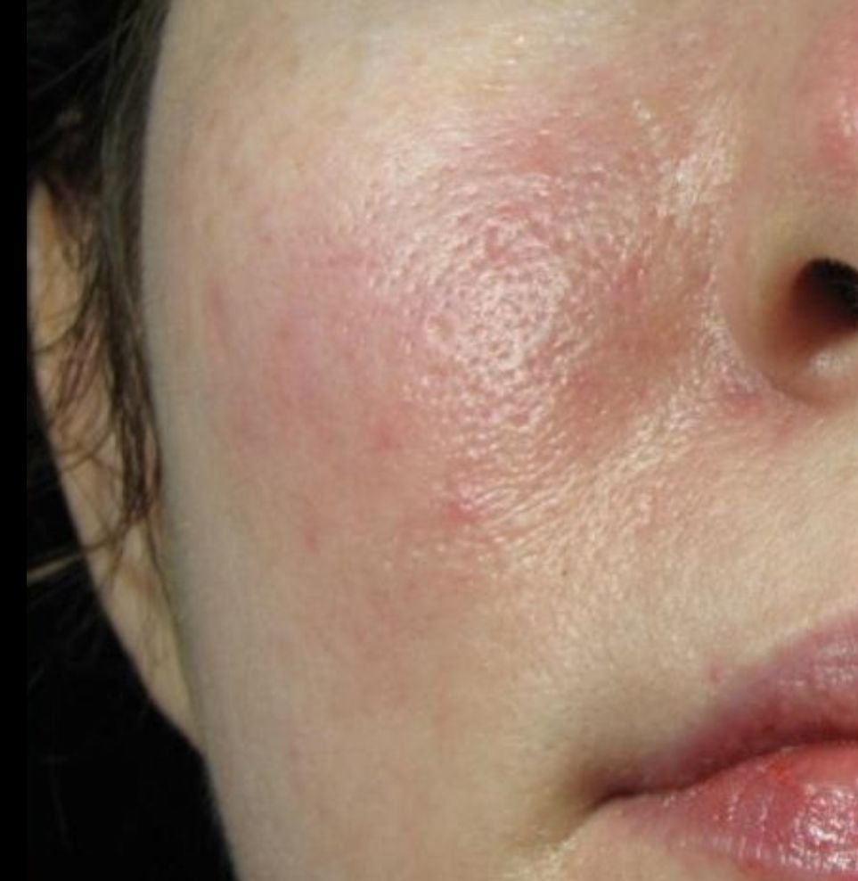 rosacea before and after london