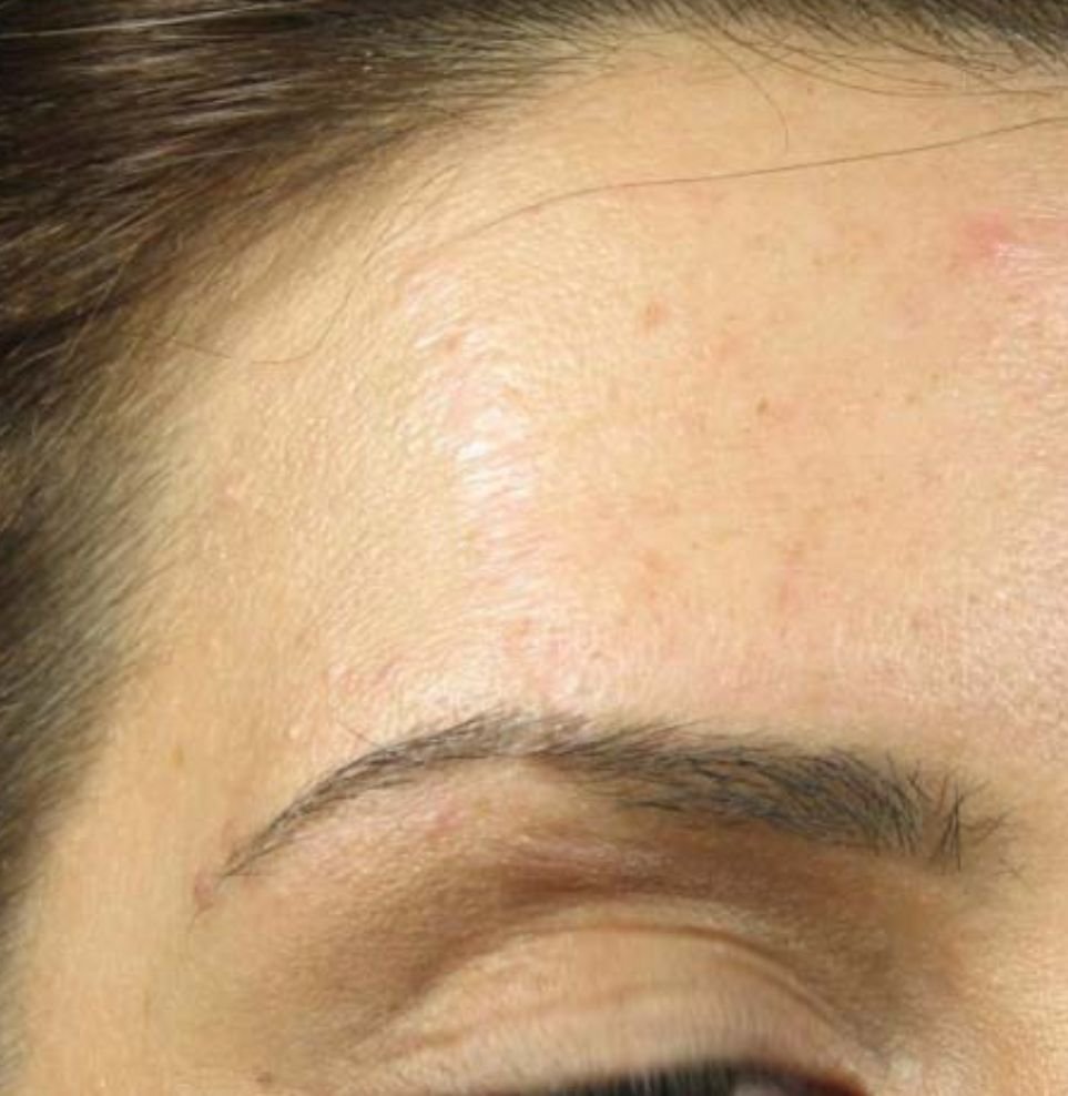 scar treatment result after
