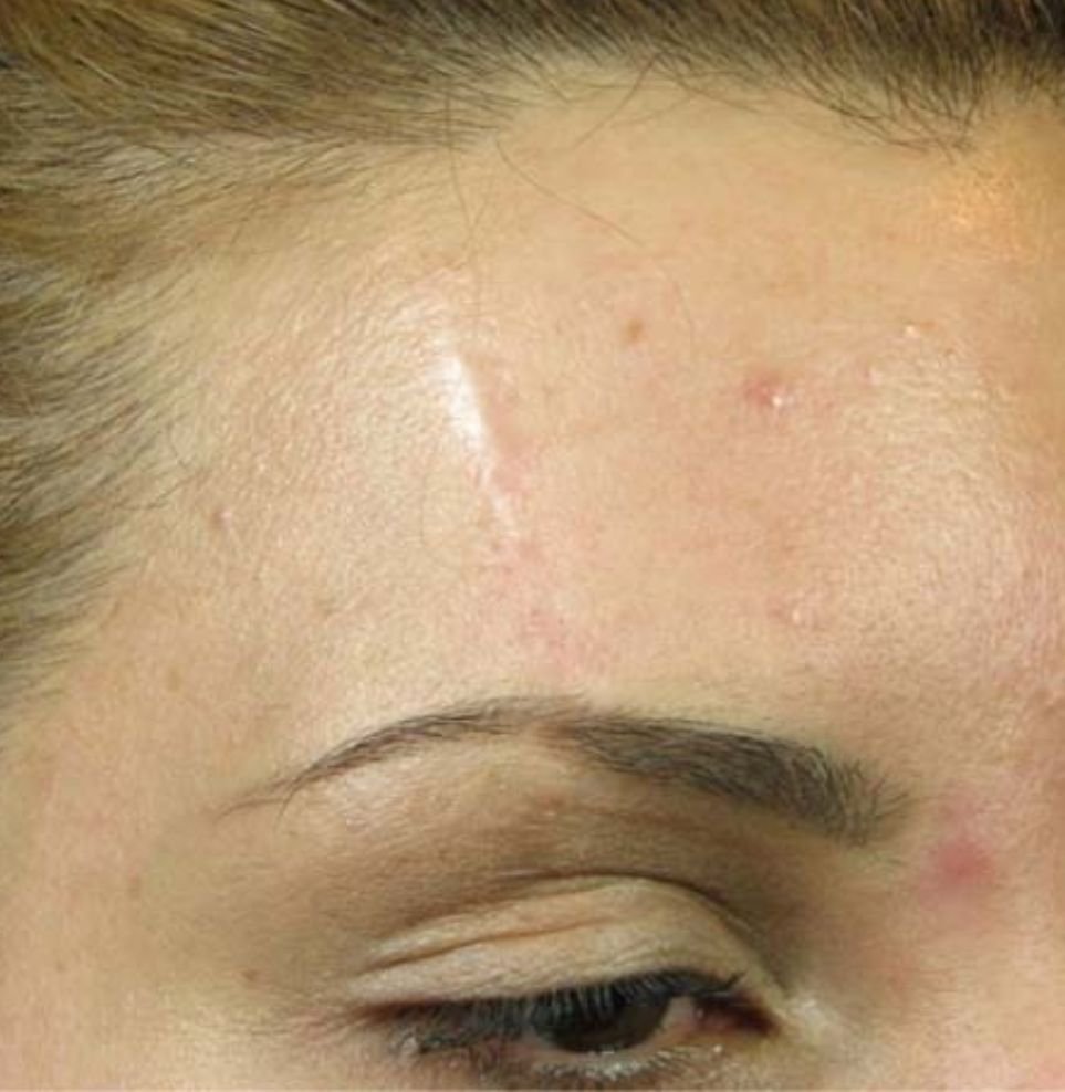 scar treatment result before