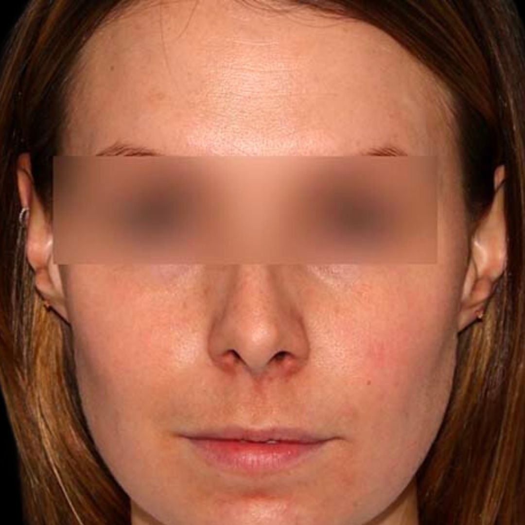 skin pigmentation result after