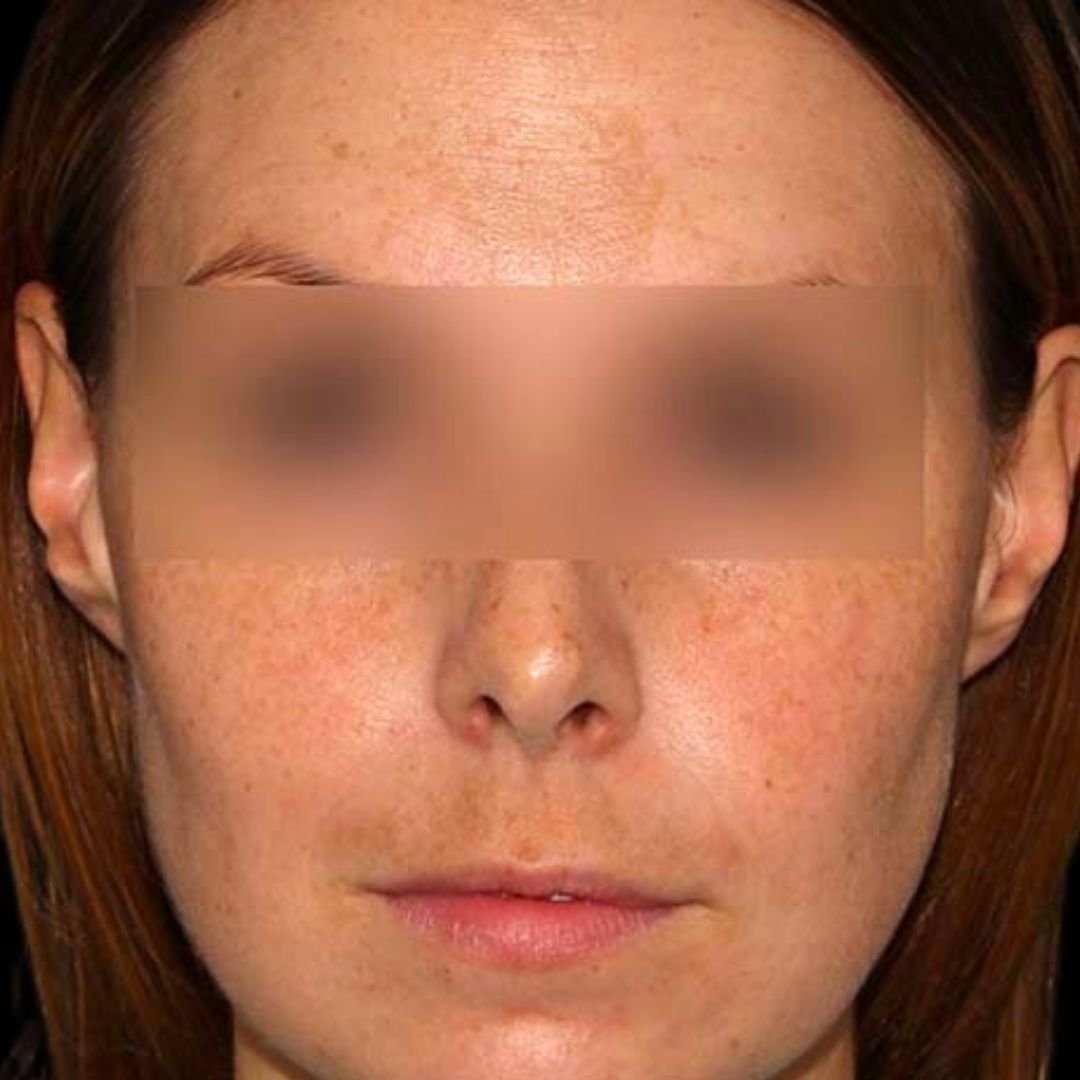 skin pigmentation result before