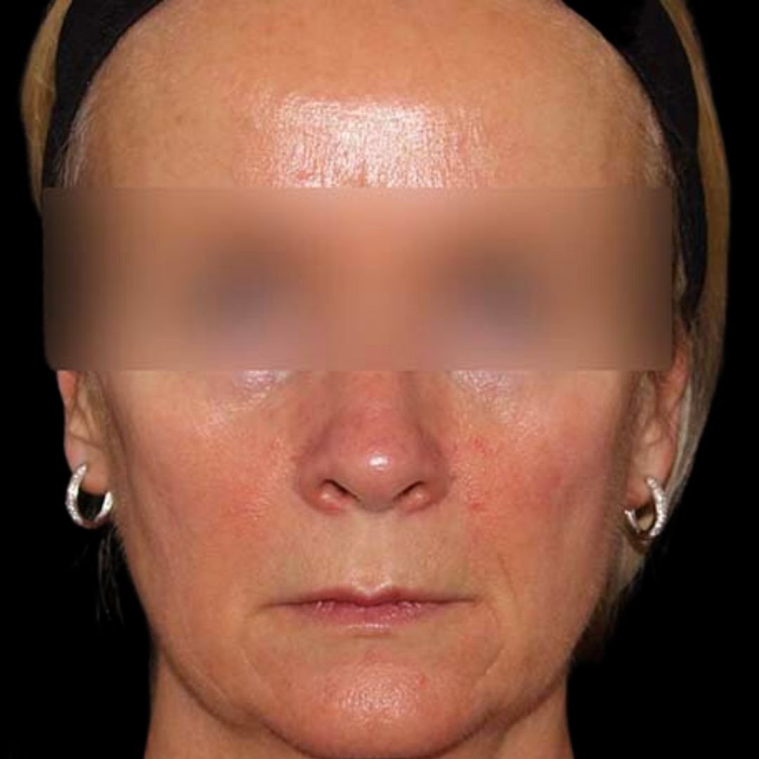 skin redness treatment after