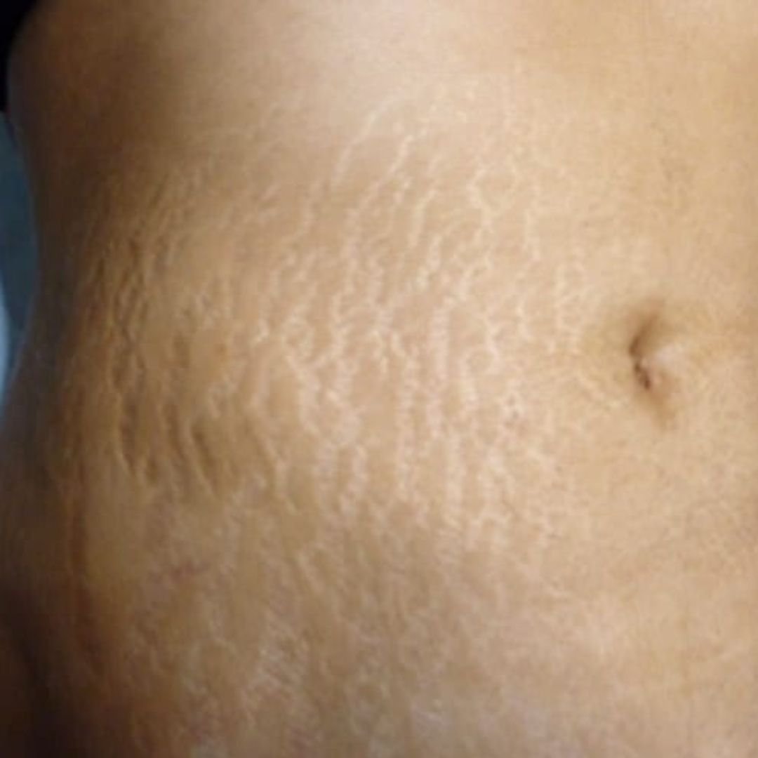 stretch marks result before