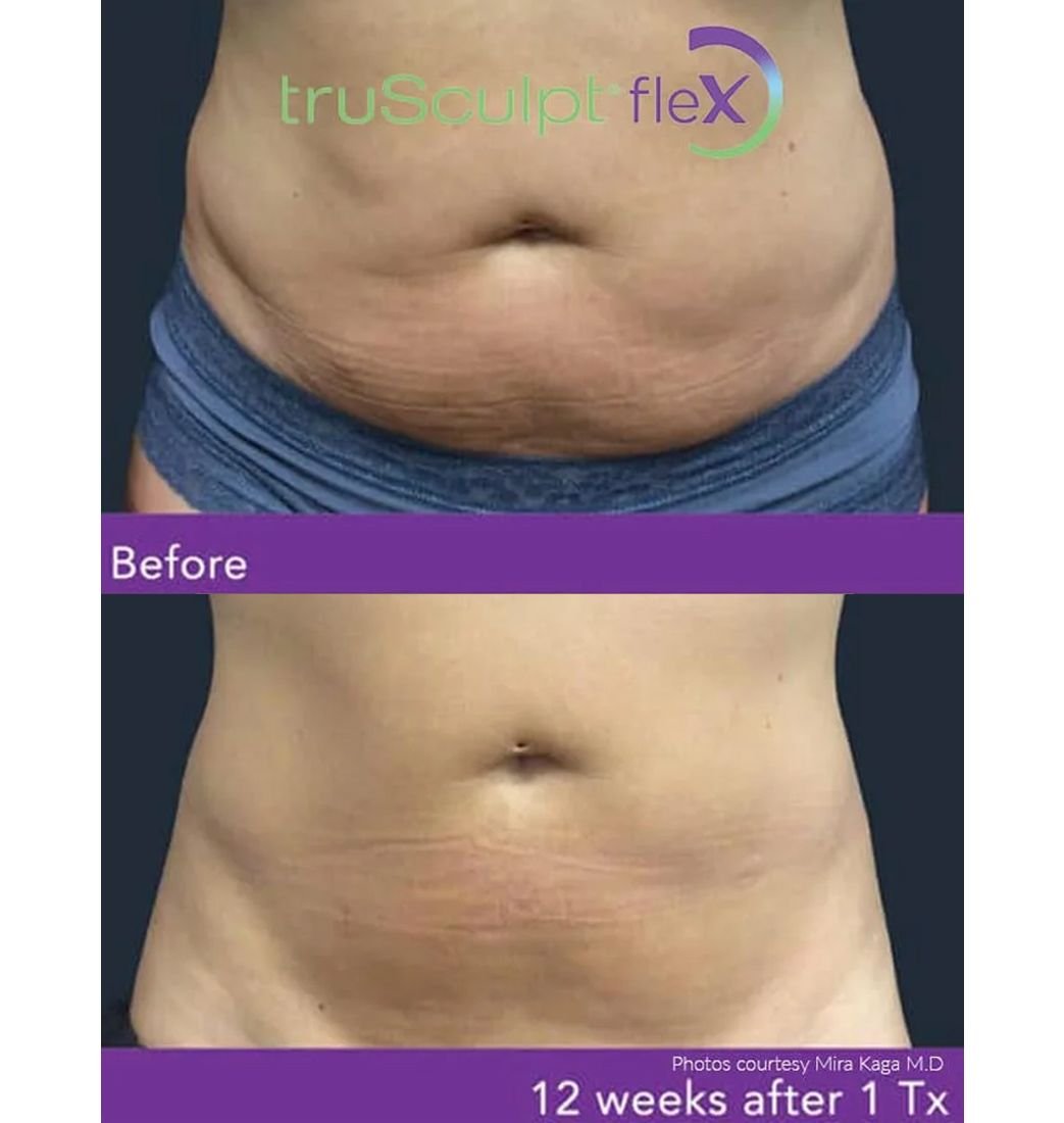 trusculpt muscle toning result
