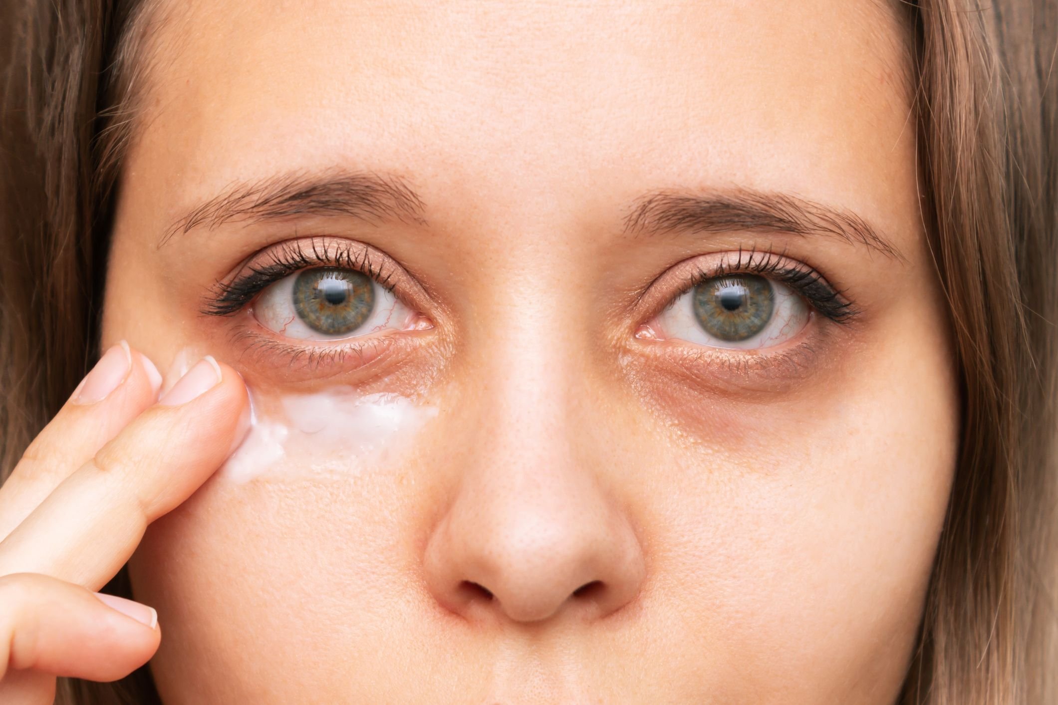 under eye bags treatment
