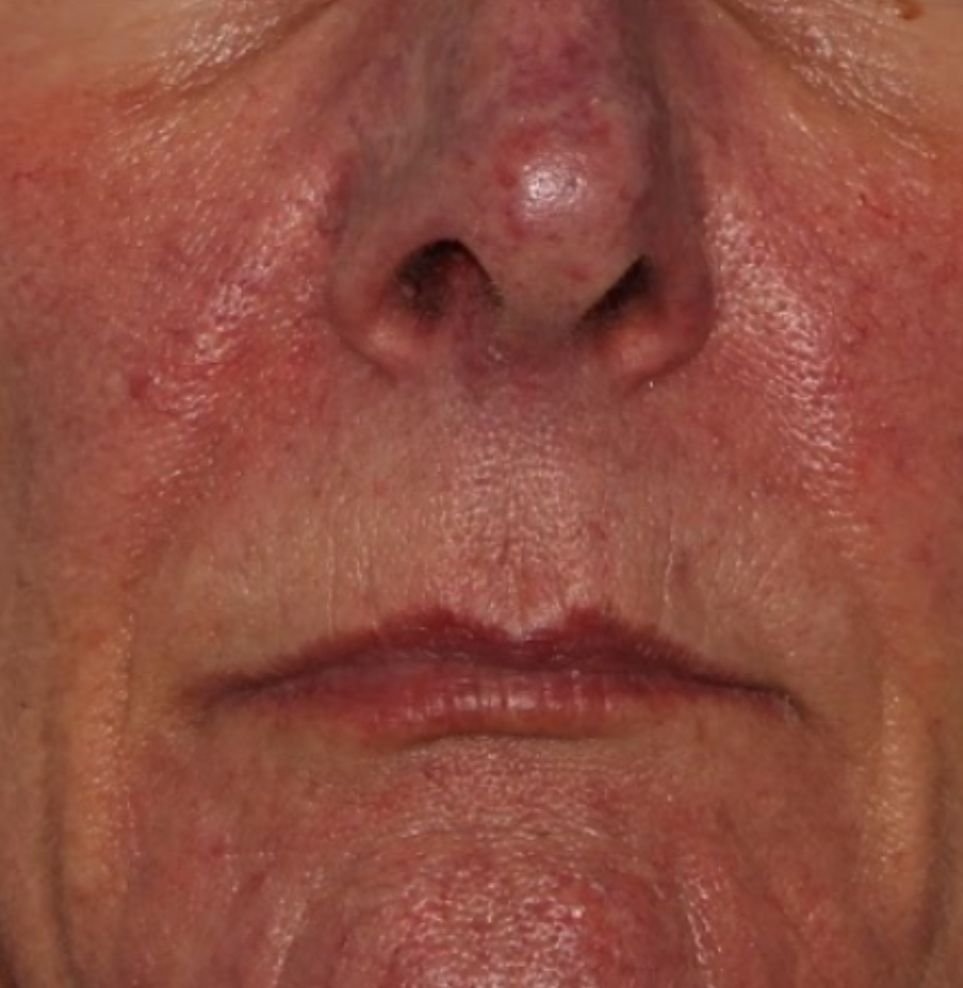 v beam redness on face  before