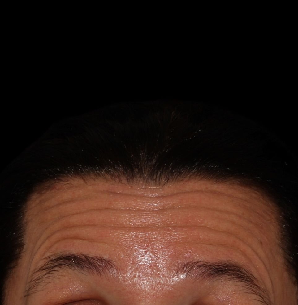 forehead lines before