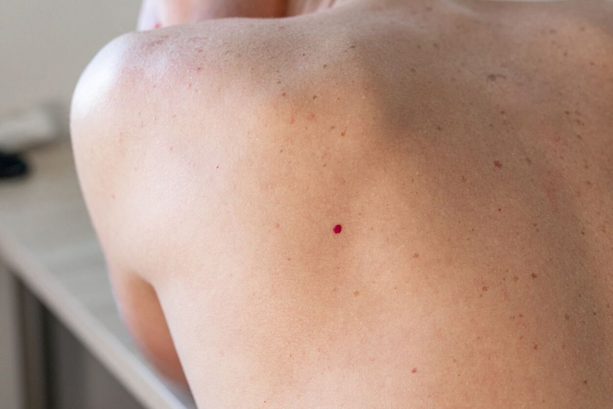 Cherry Angiomas condition image.jpg