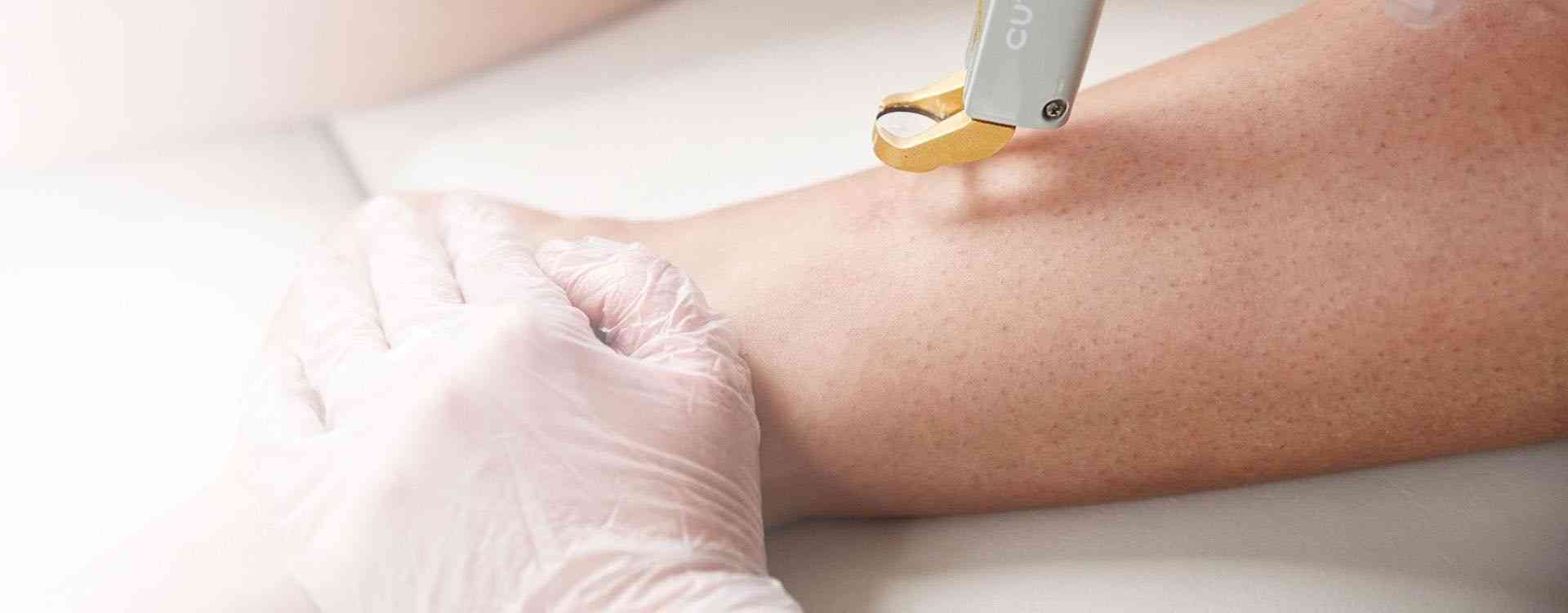 intense pulsed light treatment london clinic