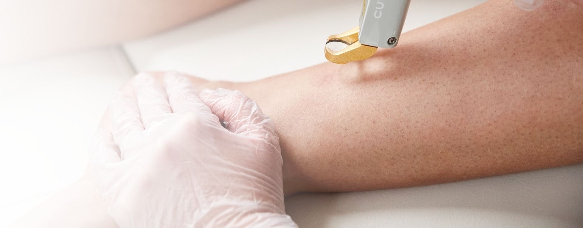 intense pulsed light treatment london clinic