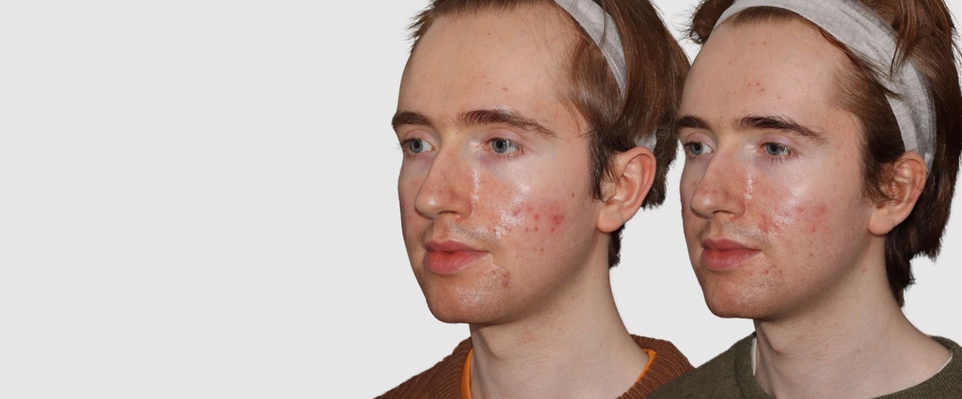 Acne before and afters