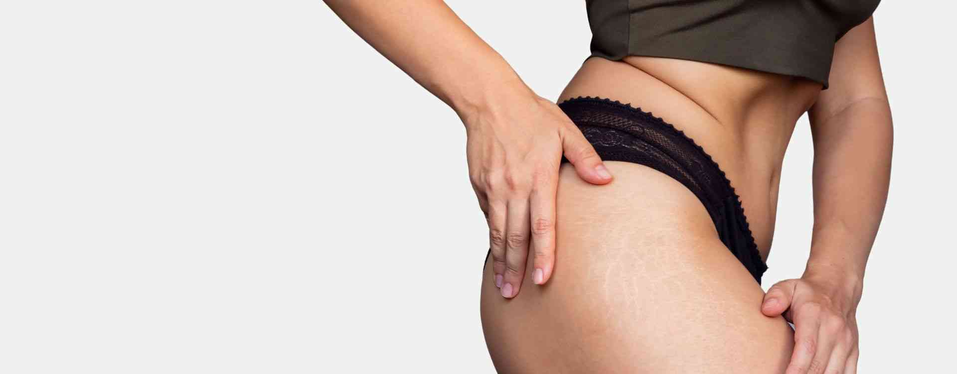 stretch marks treatment london