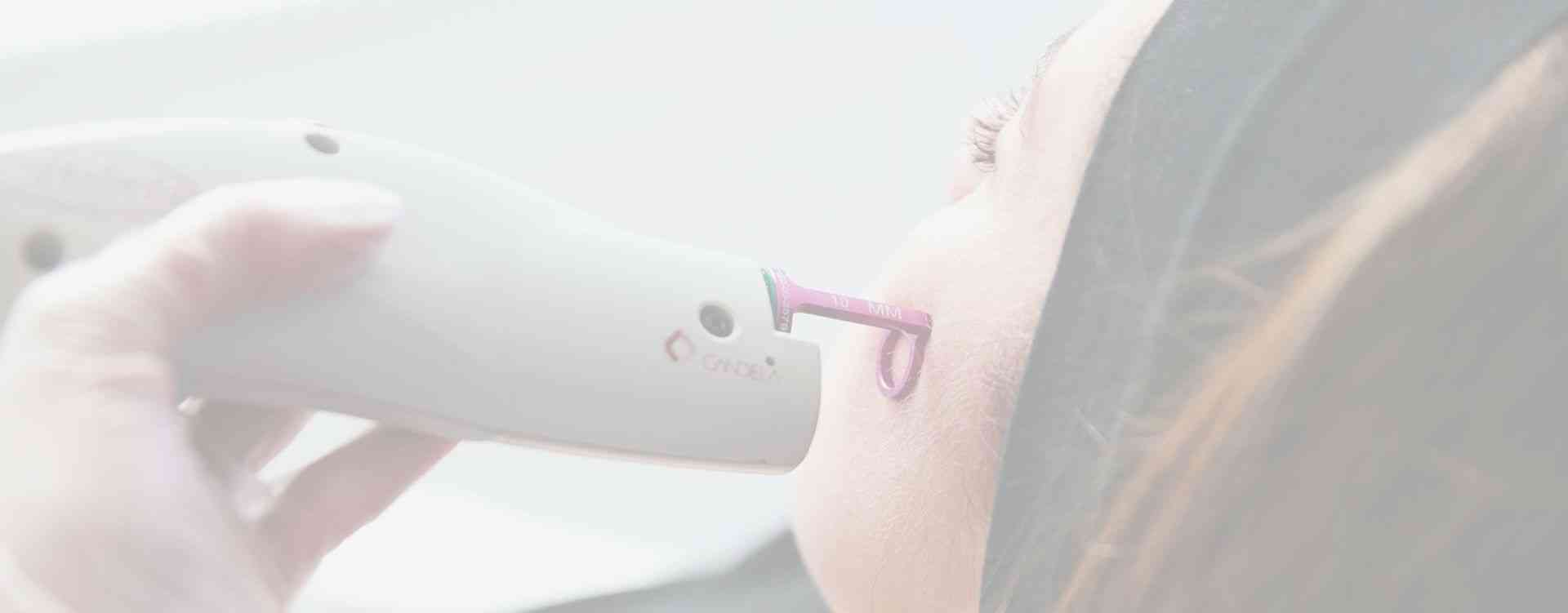 v beam damage skin treatment london clinic