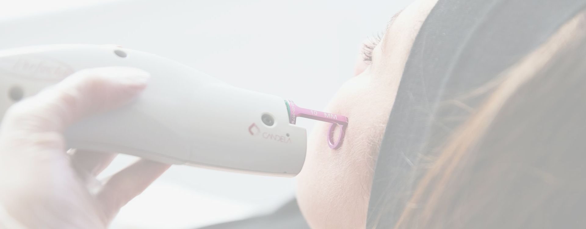 v beam damage skin treatment london clinic