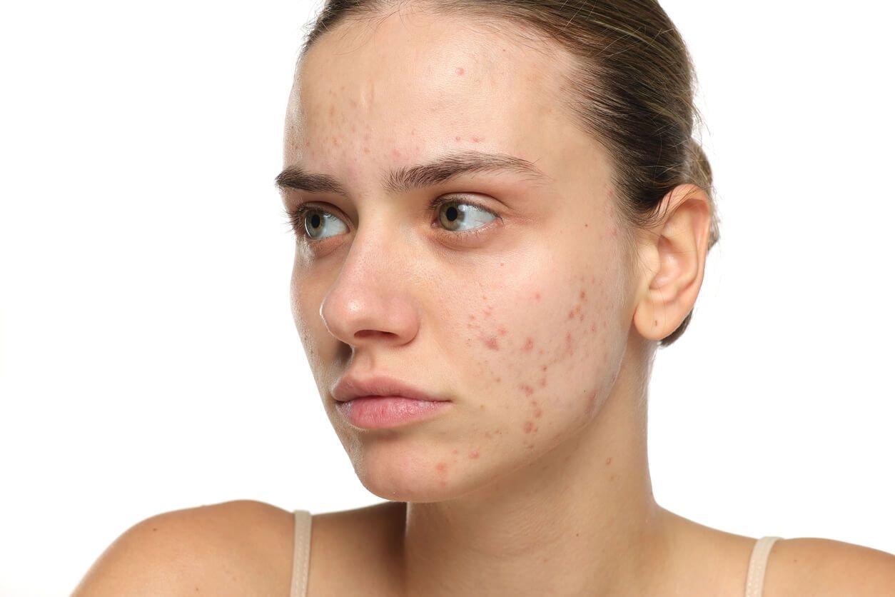 woman with acne scarring.jpg