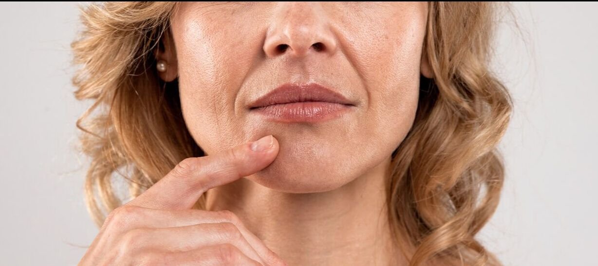 woman with deep nasolabial folds.jpg