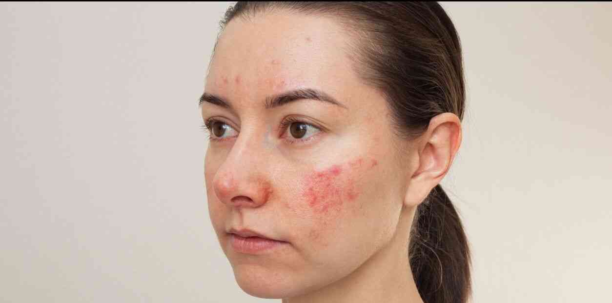 woman with rosacea on face.jpg